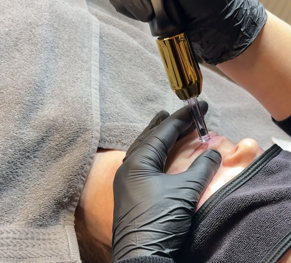 Anwendung des IRI® Filler-Systems an den Lippen im studio of senses